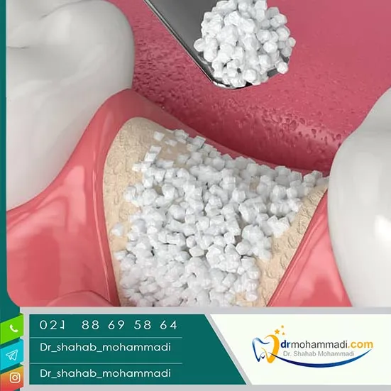 روش‌های مختلف پیوند استخوان فک: از سینوس لیفت تا پیوند بلوکی